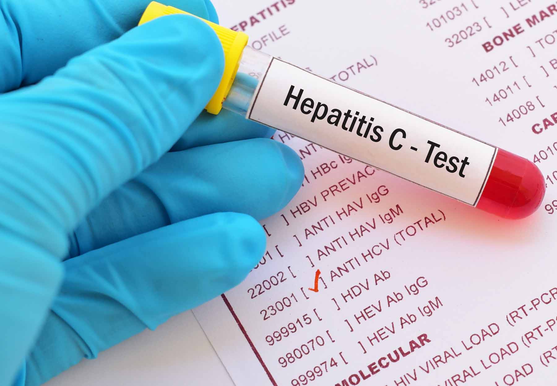 Device Reclassification Order Opens 510(k) Pathway for HCV RNA and Antibodies Tests