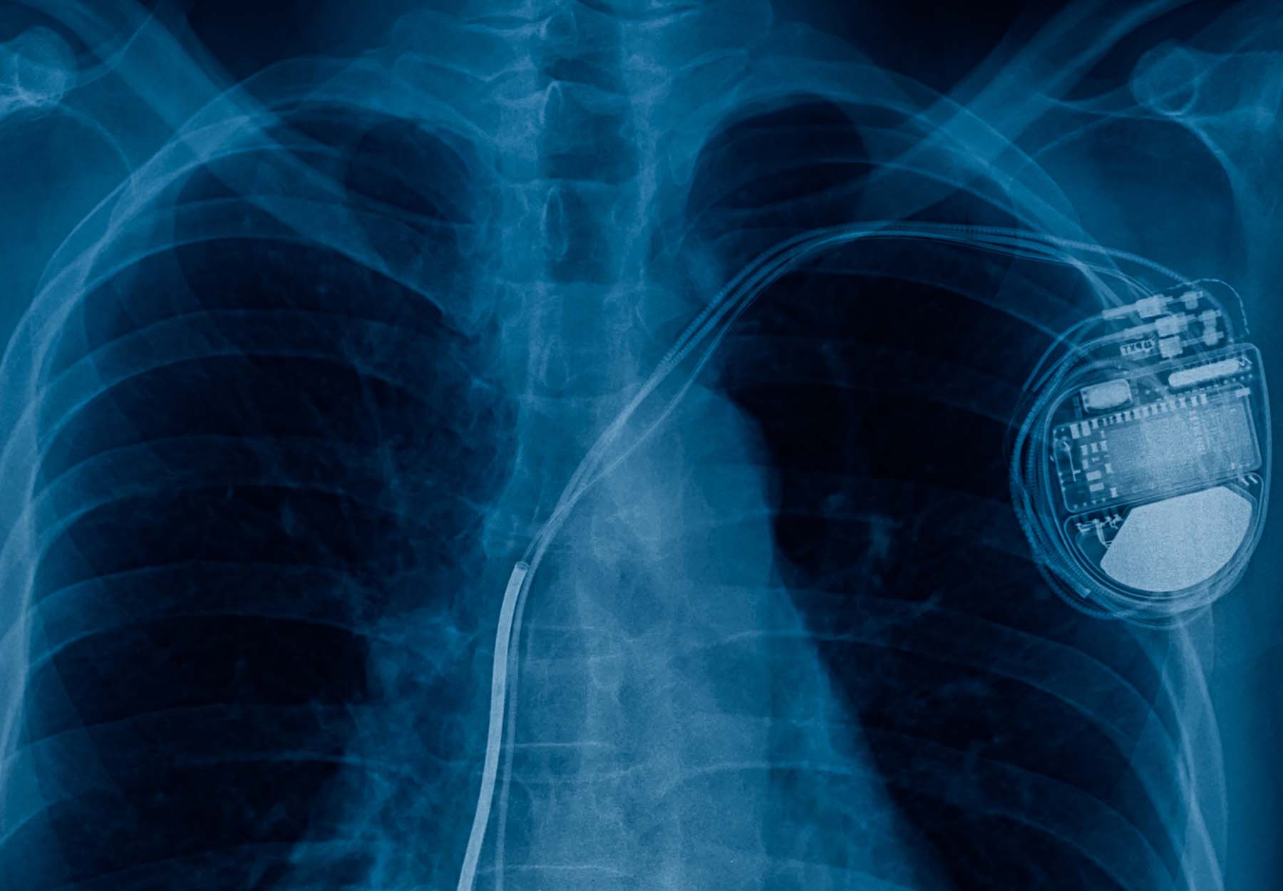 An X-ray image of a pacemaker.