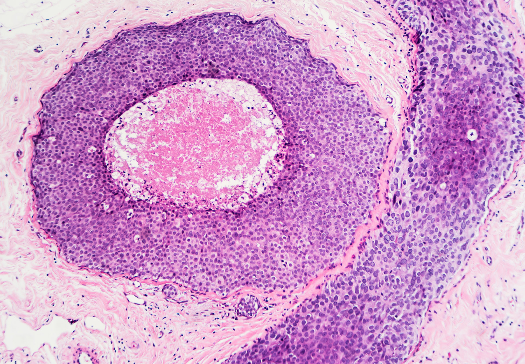 Breast cancer - ductal carcinoma in situ (DCIS): Tumor cells are confined to the mammary ducts. No invasion is seen (photographed and uploaded by US board certified surgical pathologist).