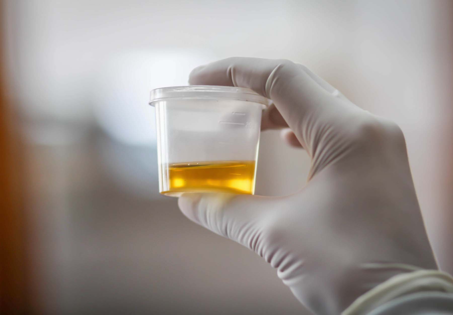 A closeup of a urine sample held by a gloved health care worker.