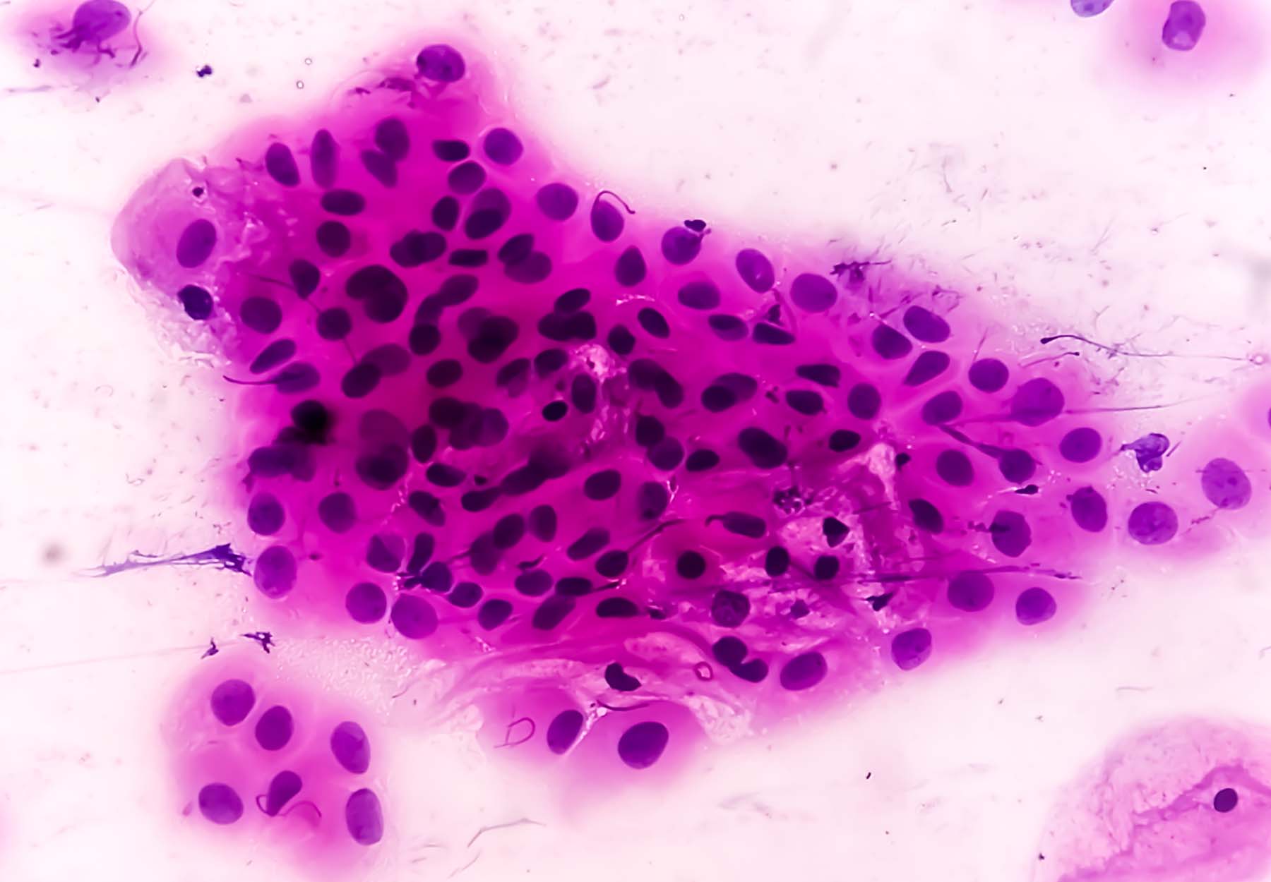 cervical cancer cells stained a bright magenta color.