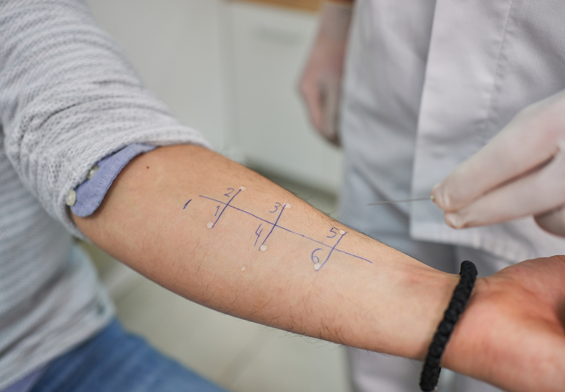 Doctor performing alergy test on a patient’s arm stock photo