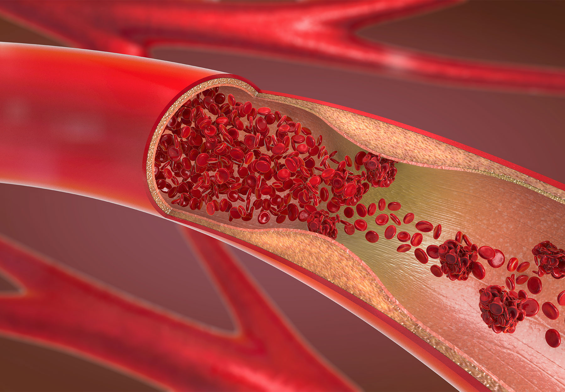 Illustration of an artery in a human heart.