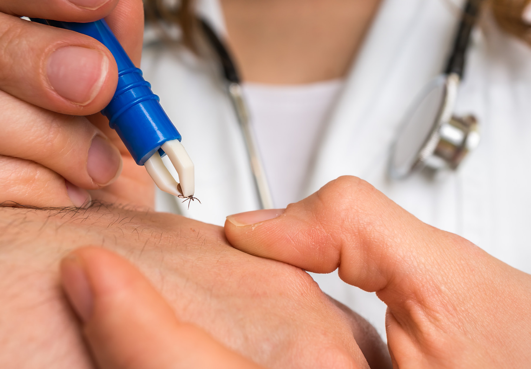 A closeup of a doctor removing a tick from a patient's hand.