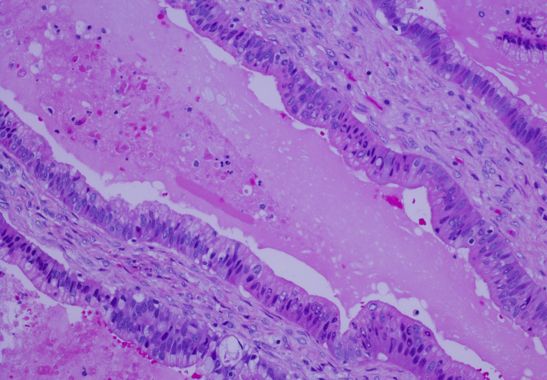 Metastatic pancreatic ductal adenocarcinoma stock photo