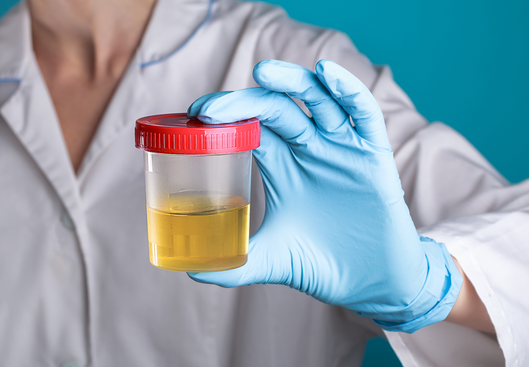 a doctor holds a urine sample in a plastic container in this stock photo