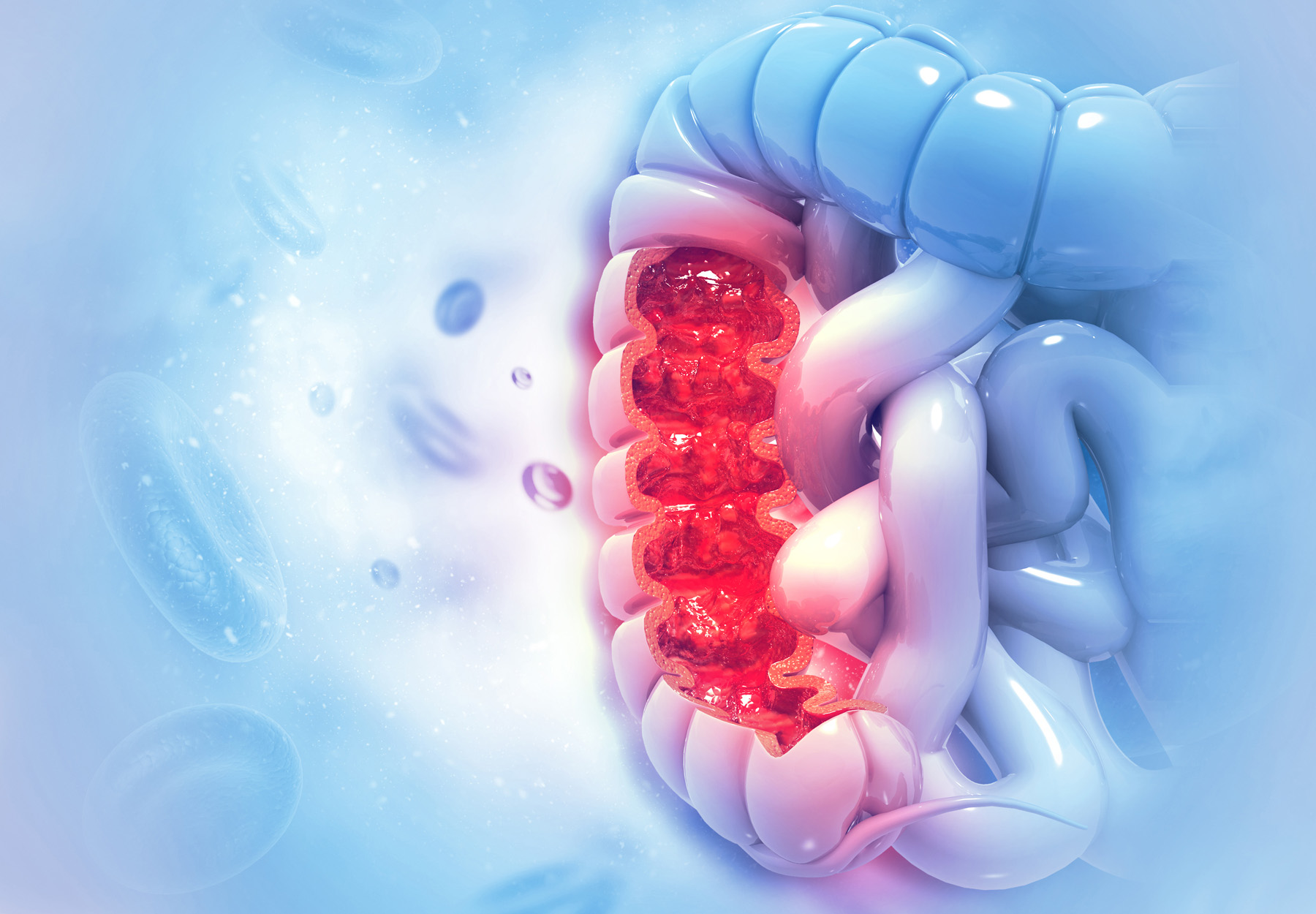 a blue stock illustration of a diseased colon with the diseased area in red