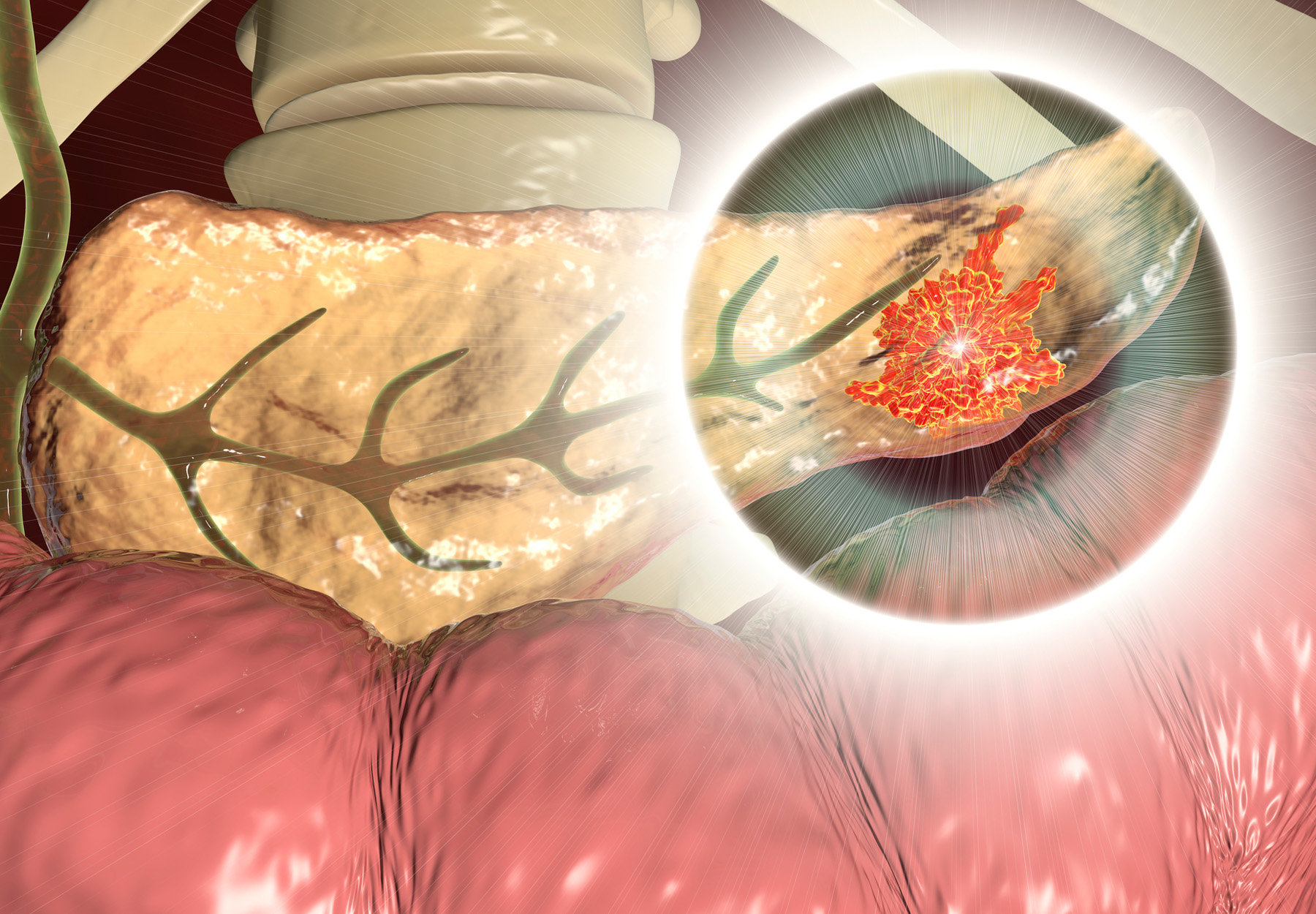 Pancreatic cancer, malignant tumor of pancreas stock illustration