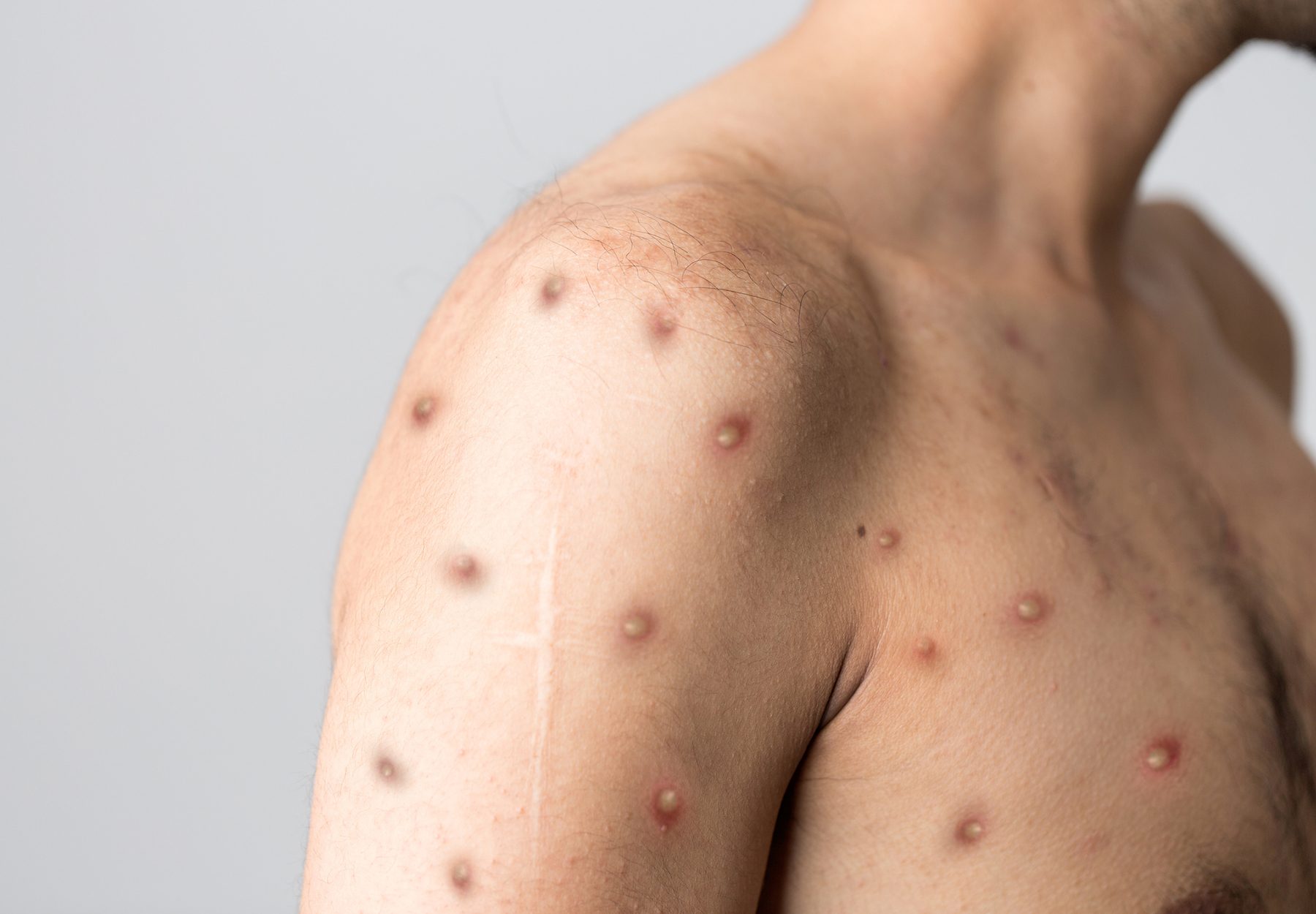 Closeup of man's shoulder and chest with monkeypox rash. Stock photo.