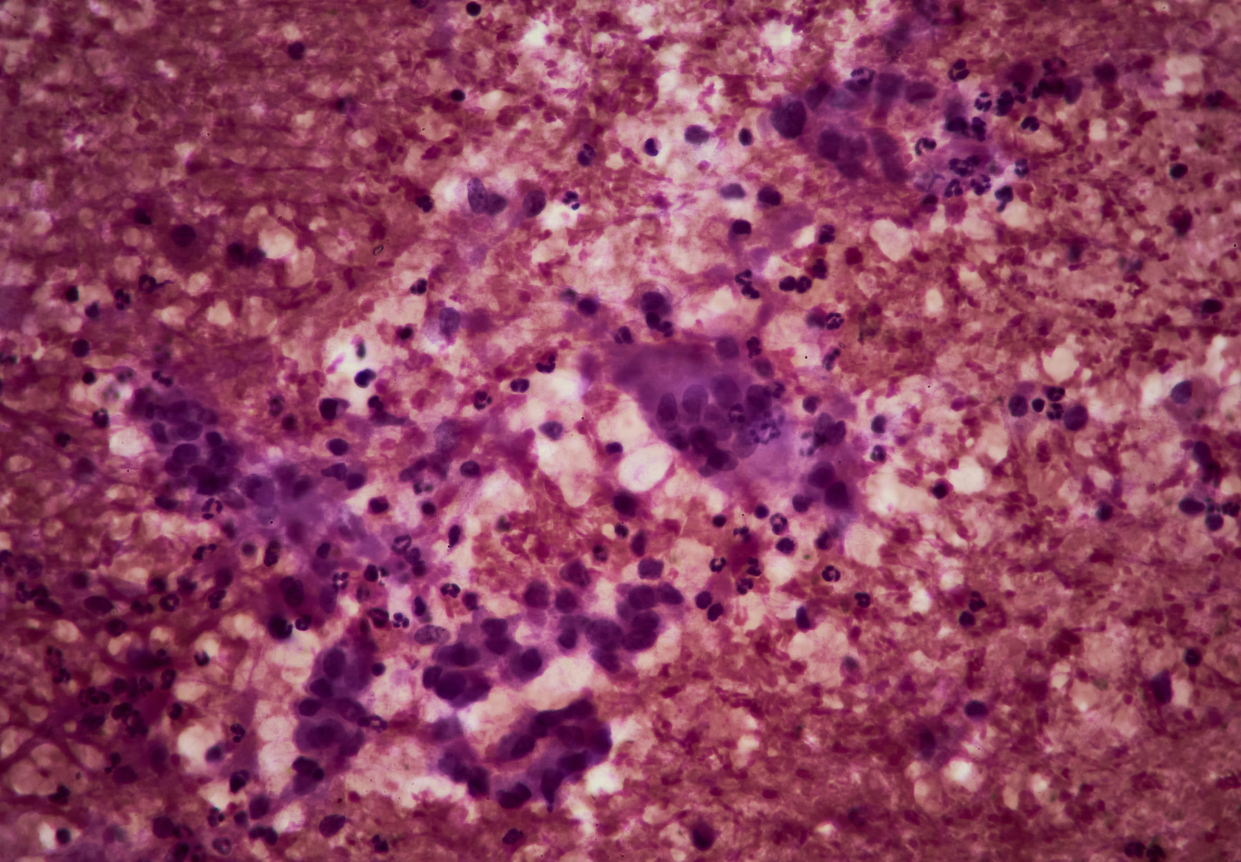 Tissue sample displaying pancreatic cancer. Stock image.