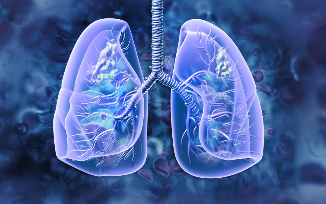 Blood-Based Tests Can Detect Early-Stage Lung Cancer