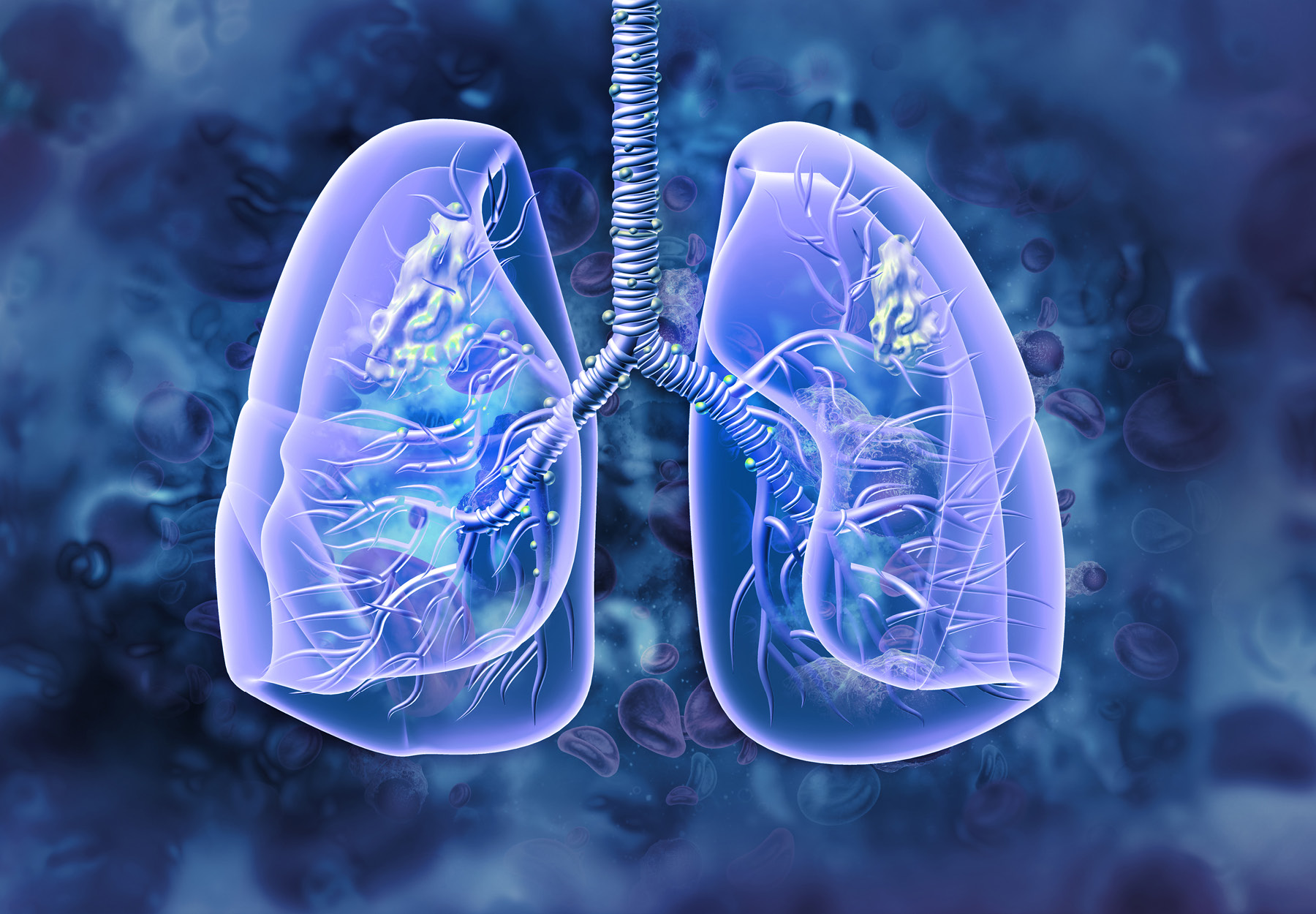 Lung cancer. lung disease. 3d illustration