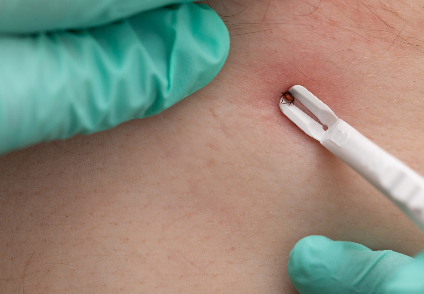 Closeup of tick being removed from person's skin with tweezers. Stock photo.