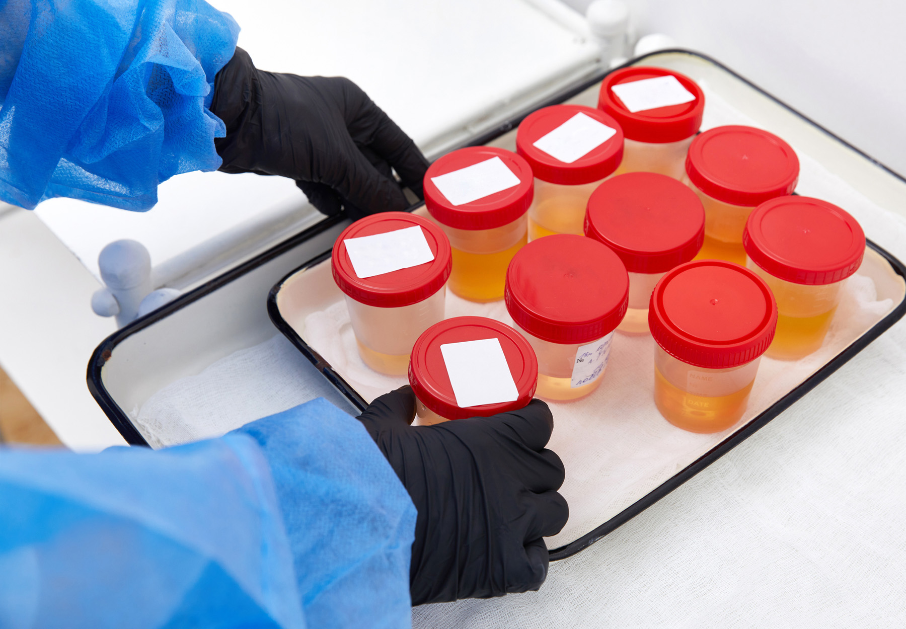 Urine analysis in laboratory. Preparation of urine samples in the hospital for the study. Stock image.