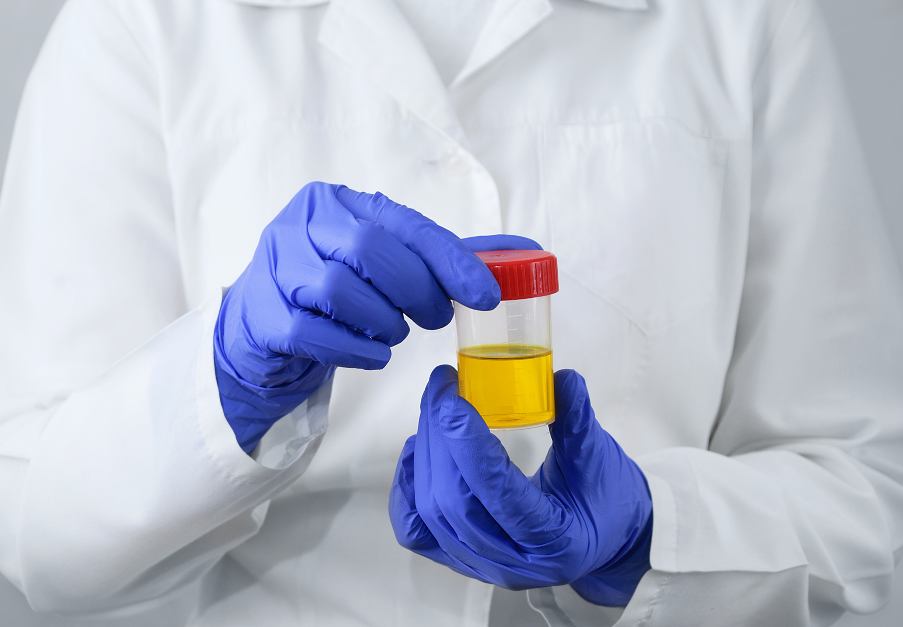 Closeup of laboratory professional's purple-gloved hands holding a urine sample. The lab worker has on a white lab coat as well. iStock image.