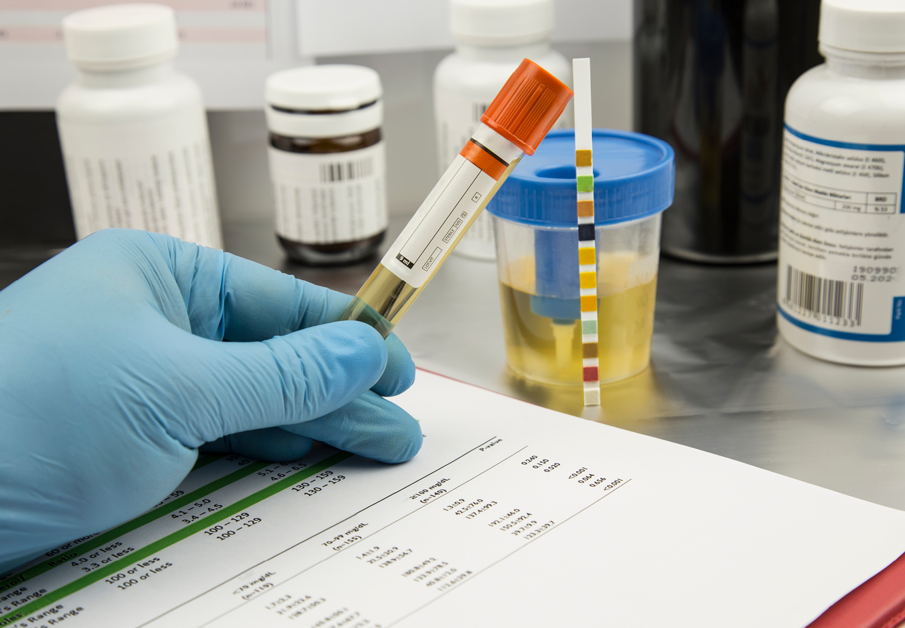 Closeup of gloved lab worker's hand holding a test tube of urine with a test strip and urine sample container in the background. Urine testing concept. iStock image.