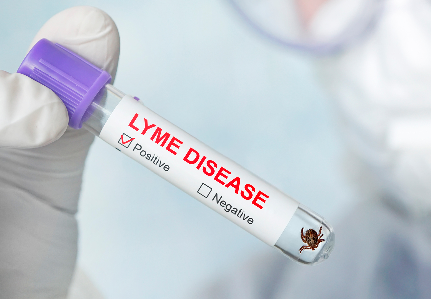 Lyme disease label on a test tube in the hands of a laboratory assistant dangerous iStock image