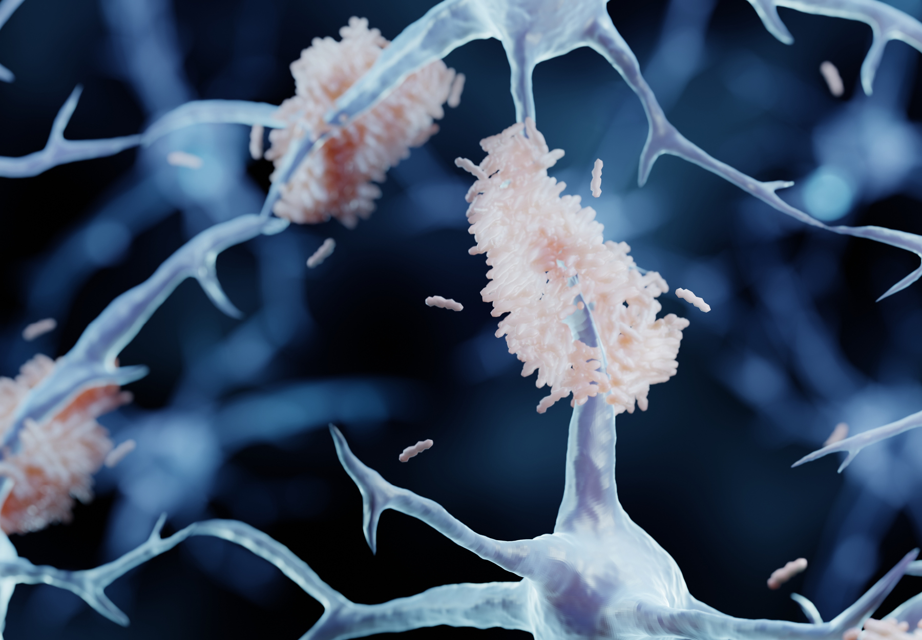 Amyloid plaques in alzheimers disease istock image