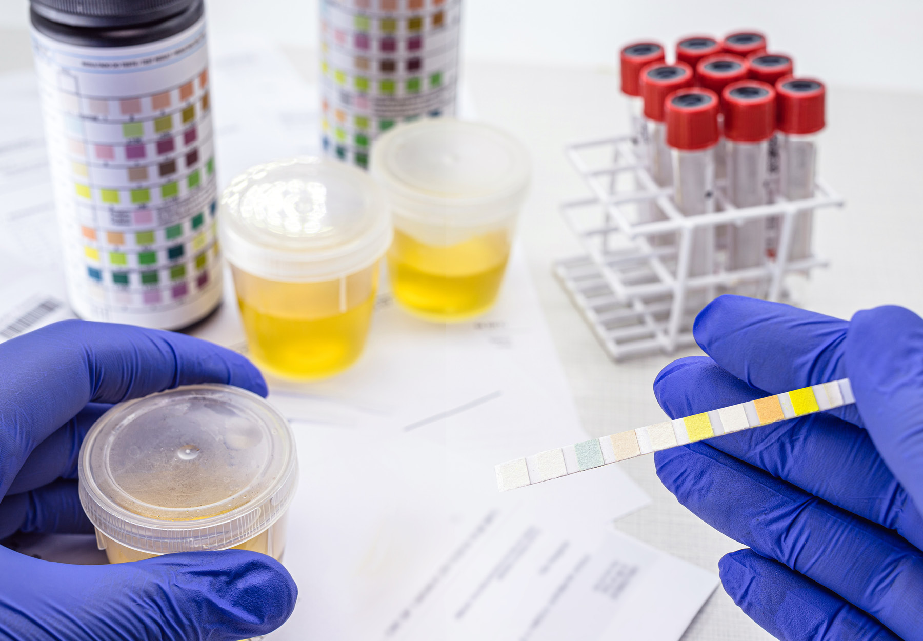 Lab technician's hands holding reagent strip, analyzing urine and blood samples.