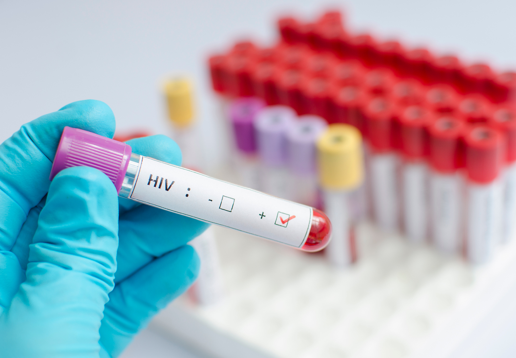HIV blood sample iStock Image