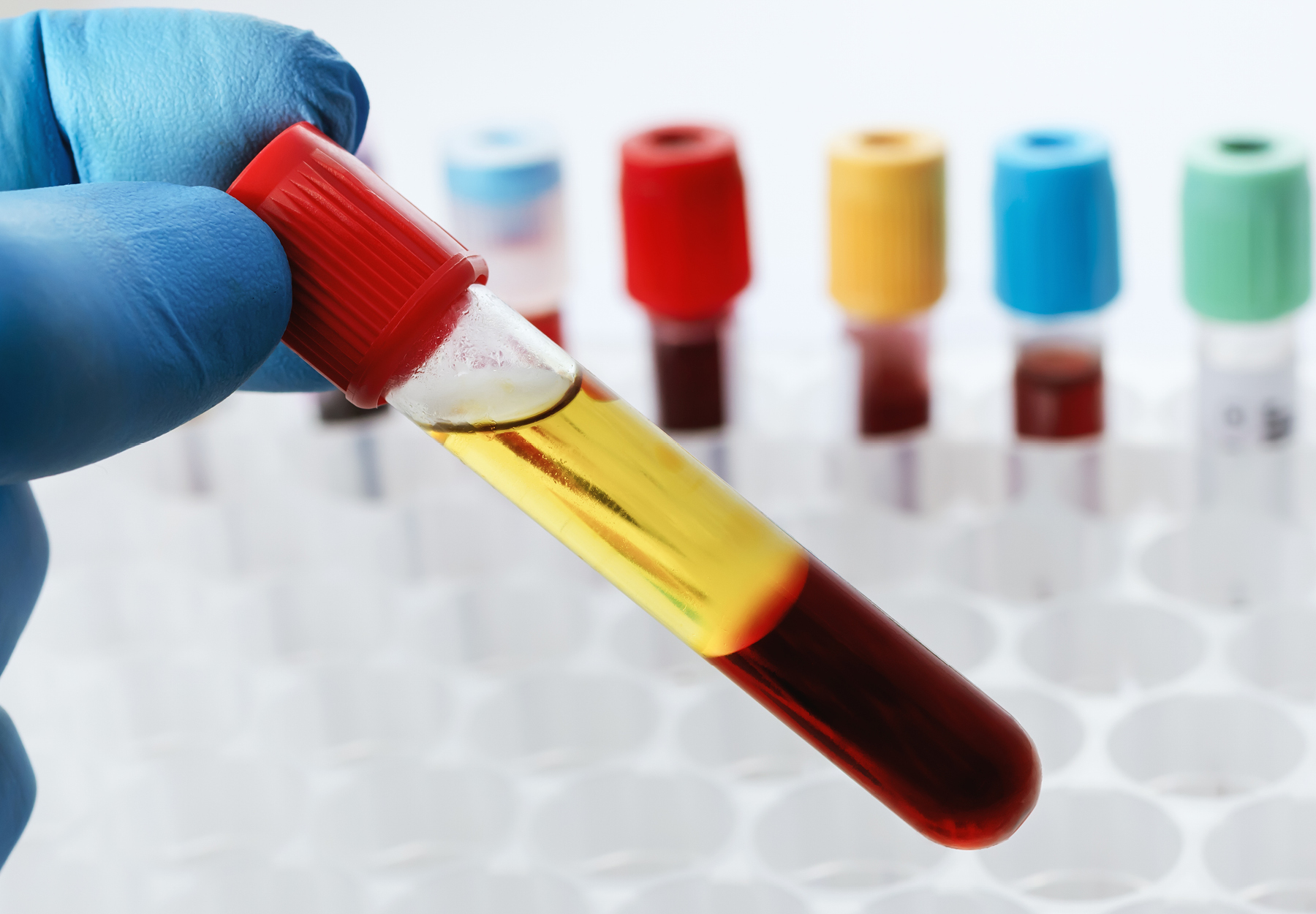 Lab technician holding a test tube of blood sample after being centrifuged iStock image