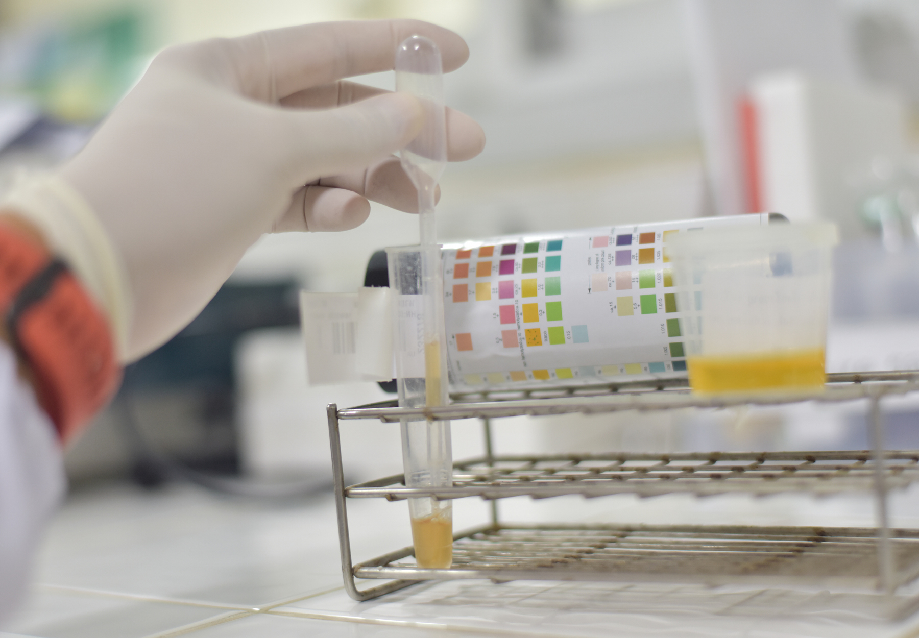 A closeup of the gloved hand of a lab professional doing urinalysis in the lab with a test tube and sample cup of urine and multi-colored indicator strips. iStock image.