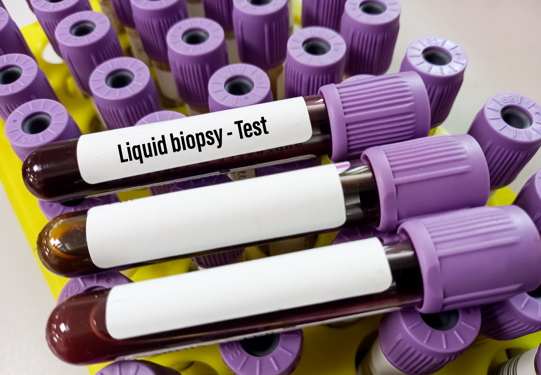 Blood samples for Liquid biopsy blood test.