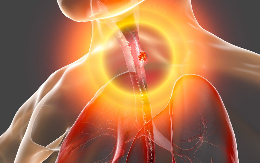 FDA Watch: New Test for Esophageal Conditions is Coming to the US