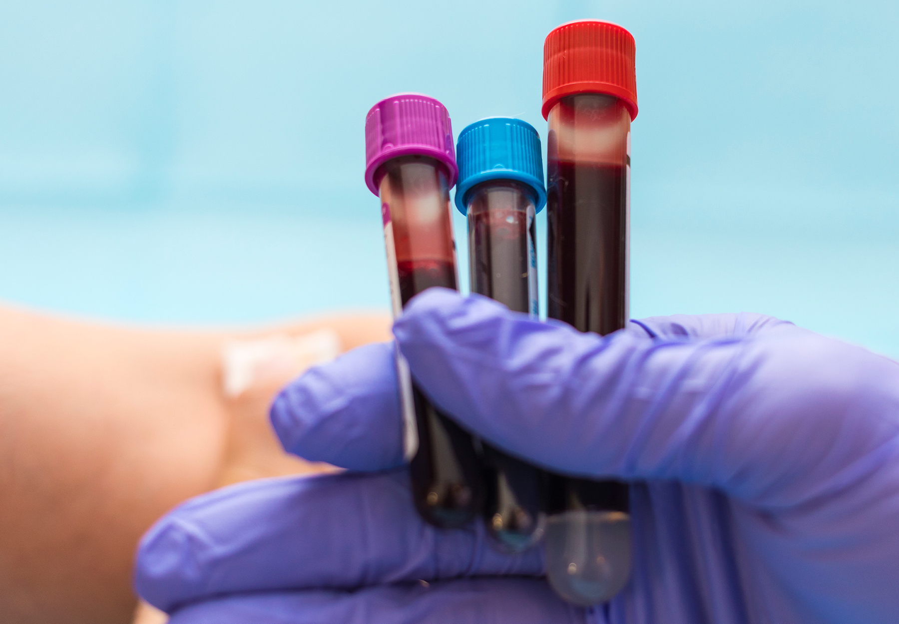 Common blood draw challenges include inadequate skin preparation and forceful blood draws.