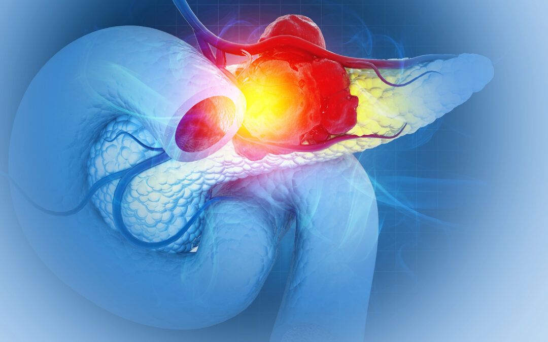 ClearNote Health Launches Early Detection Test for Pancreatic Cancer