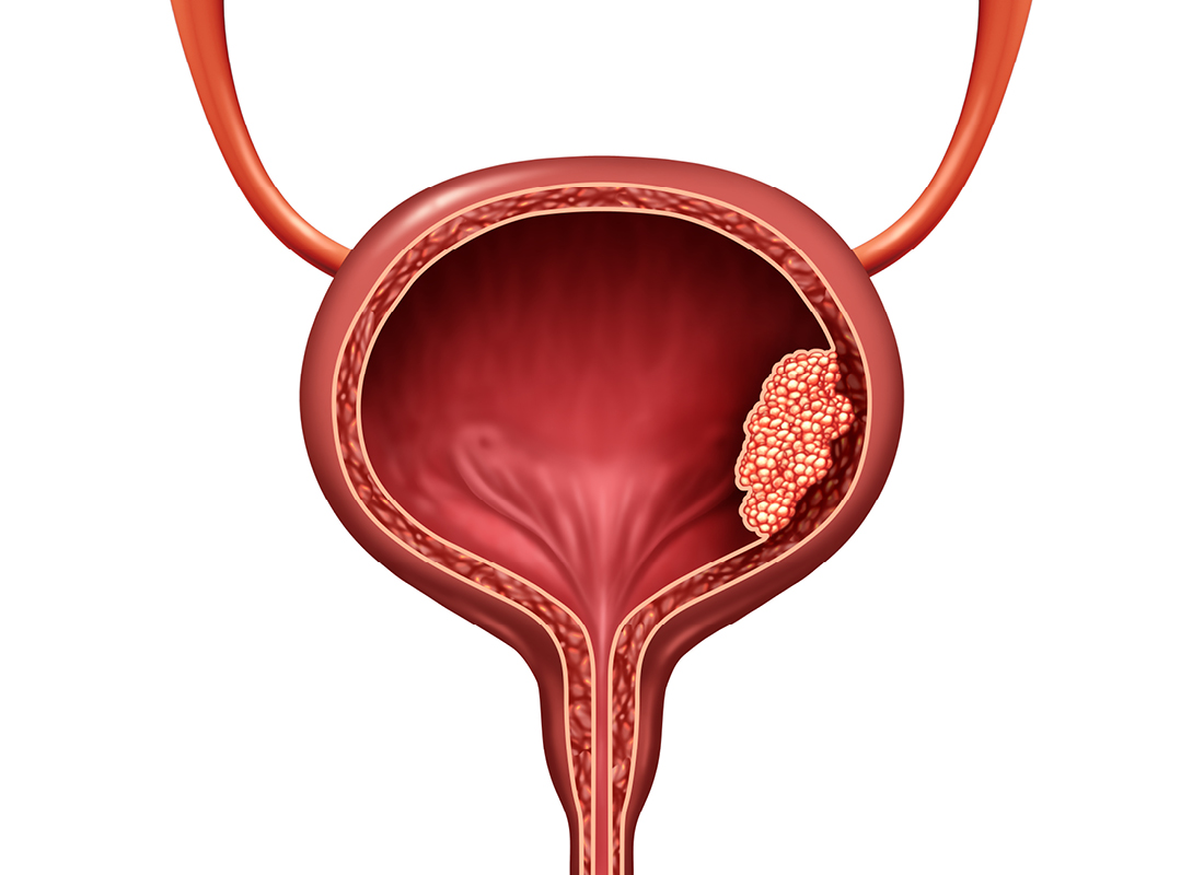 Two companies received FDA approvals for bladder cancer tests