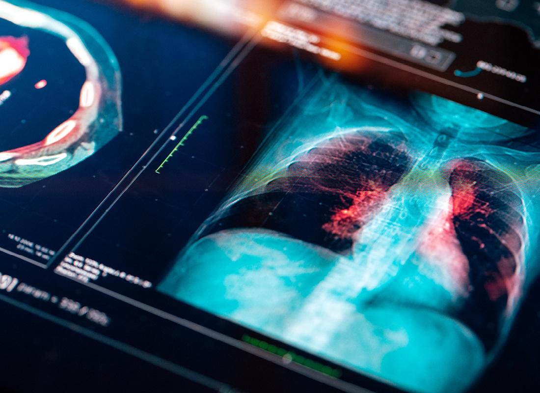 Cizzle Bio launched a new lung cancer test.