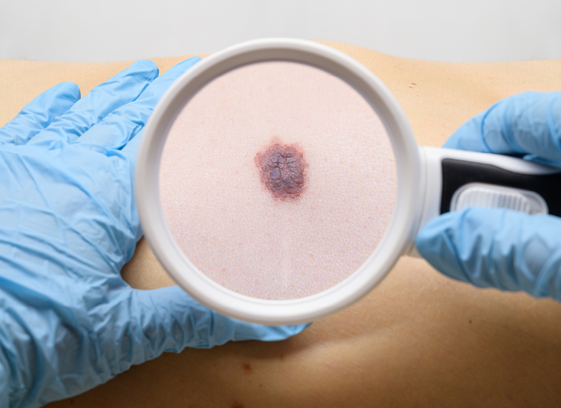 Magnifying glass showing malignant skin.